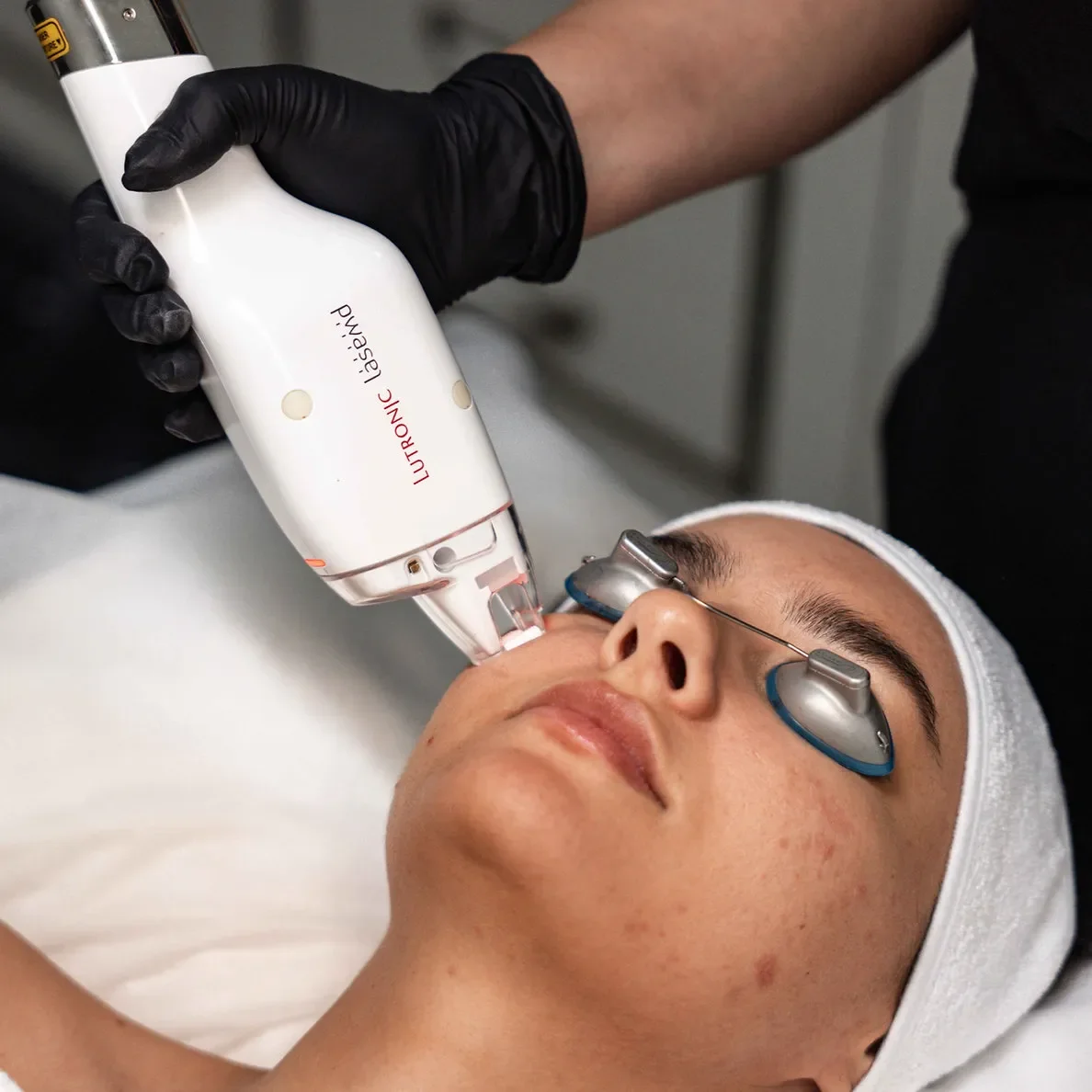 LaseMD Laser Skin Resurfacing being performed on a patient at Avanti Aesthetics